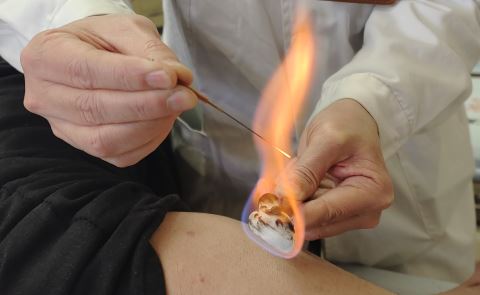 你知道神奇的针灸法之火针吗